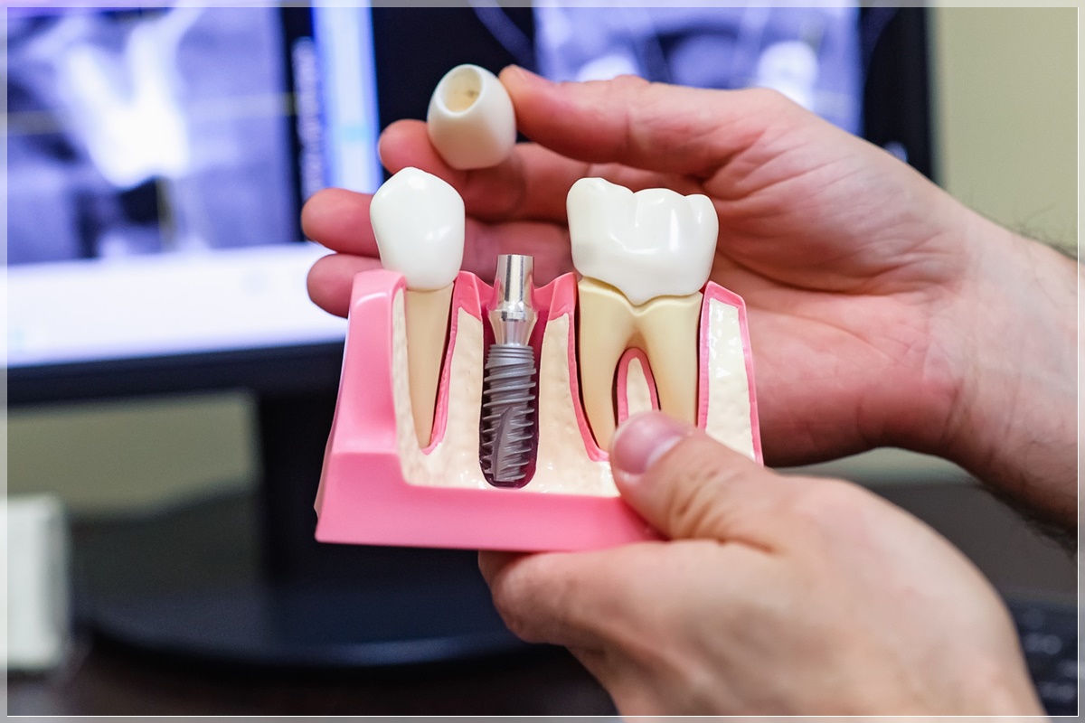 implant